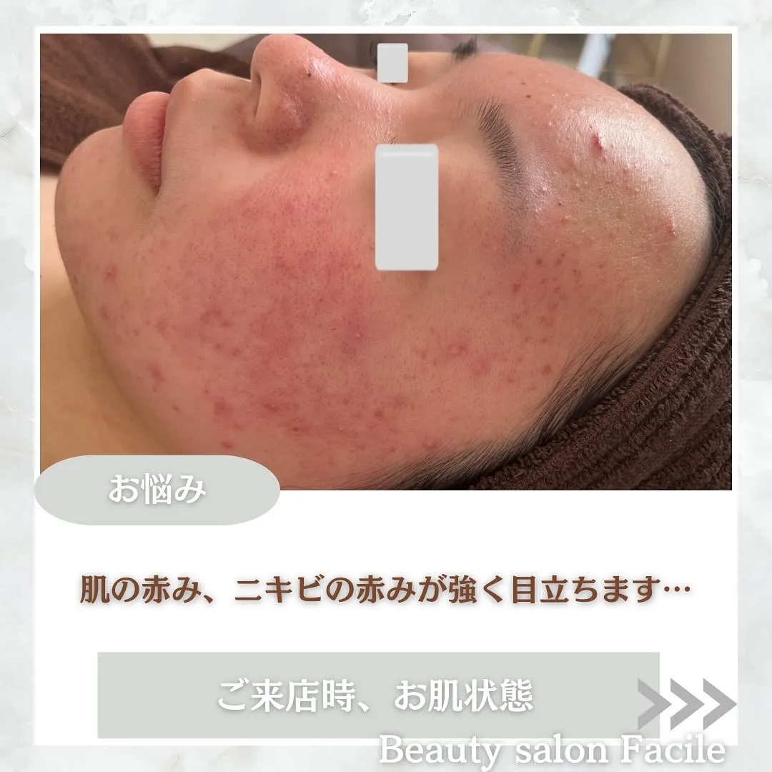 太田市にある頑固なニキビ専門店です✨️