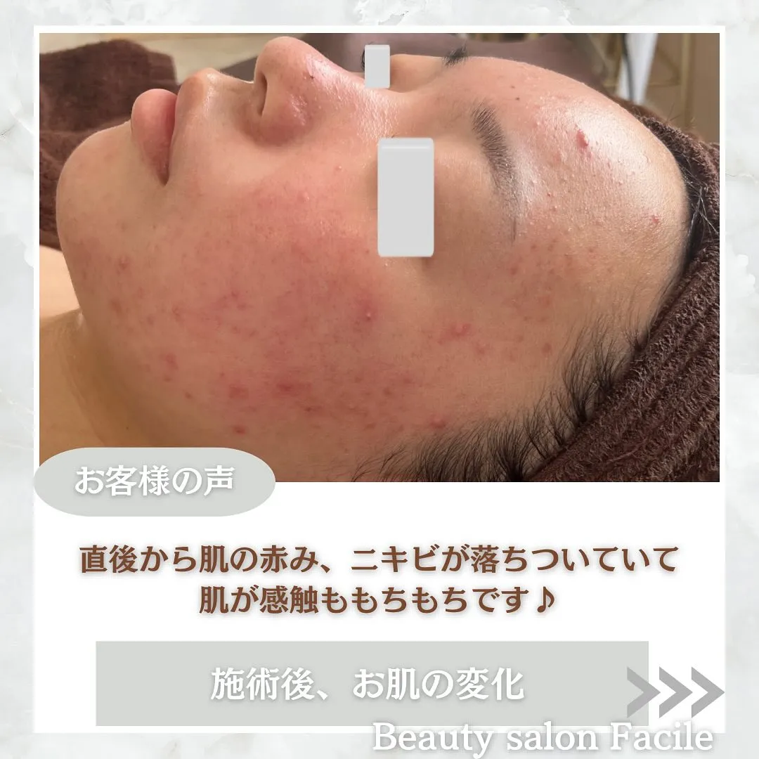 太田市にある頑固なニキビ専門店です✨️