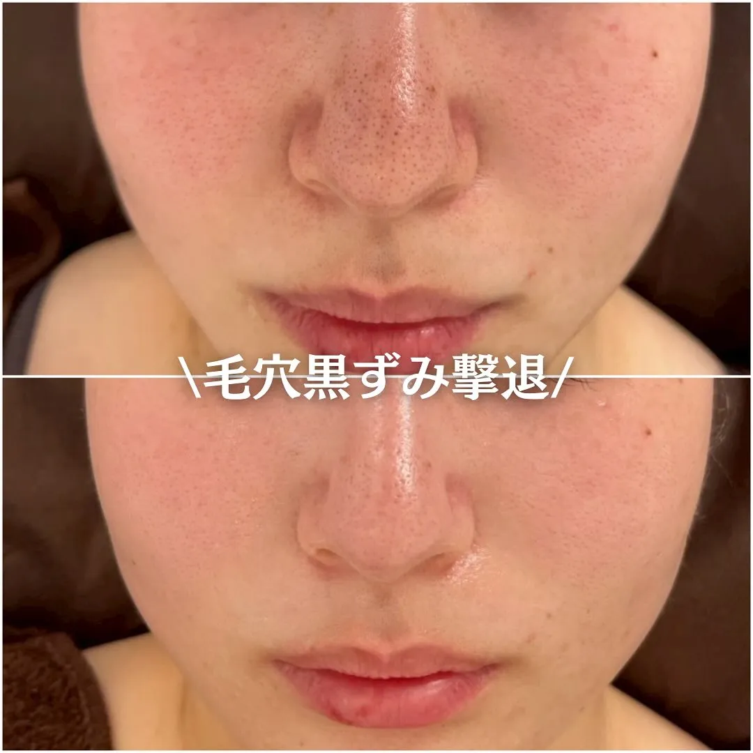 太田市にある頑固なニキビ専門店です✨️