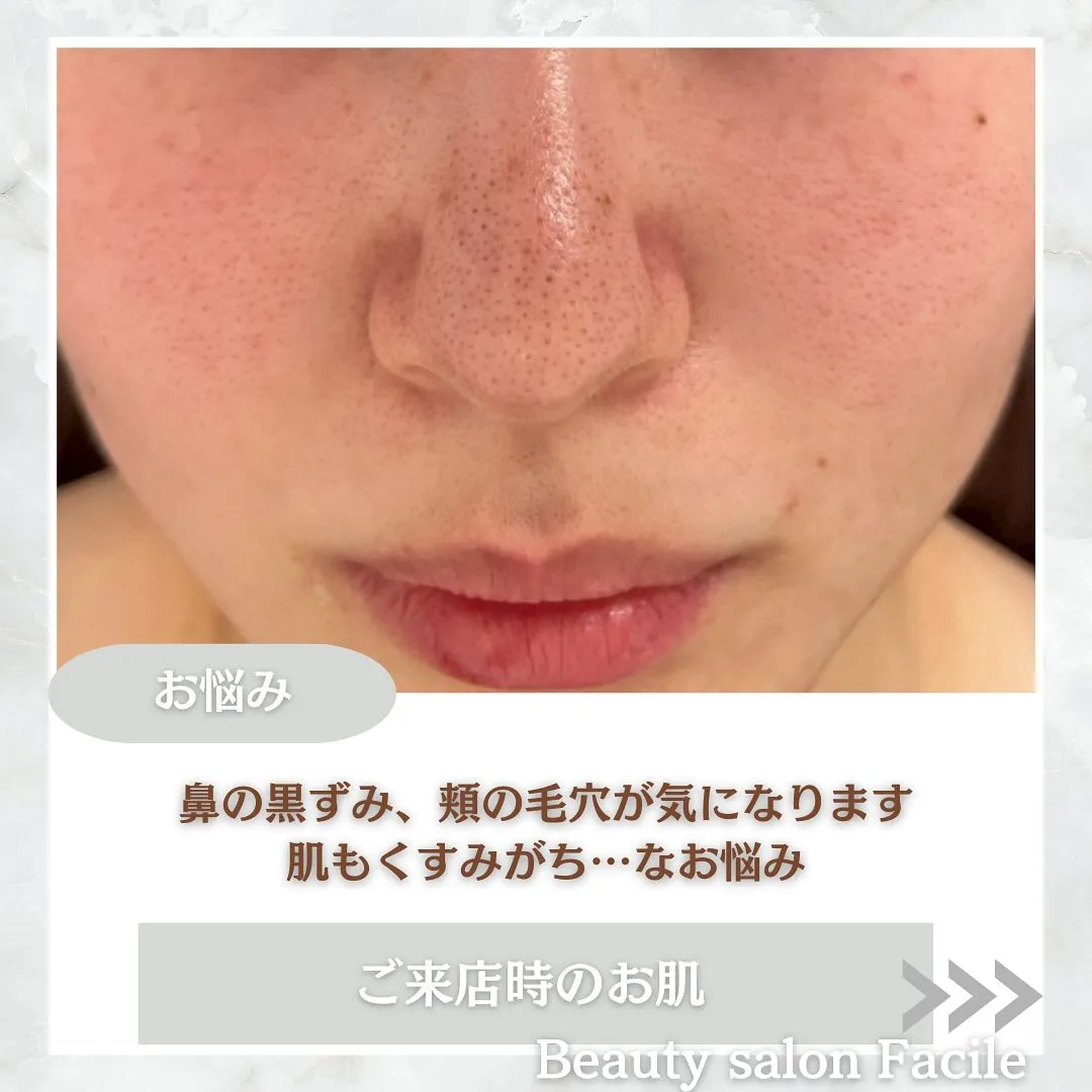 太田市にある頑固なニキビ専門店です✨️