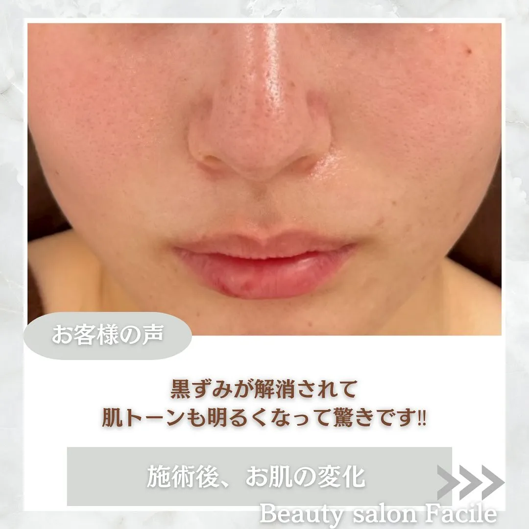 太田市にある頑固なニキビ専門店です✨️