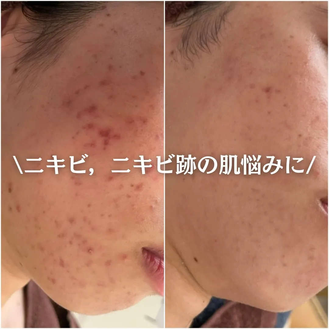 太田市にある頑固なニキビ専門店です✨️