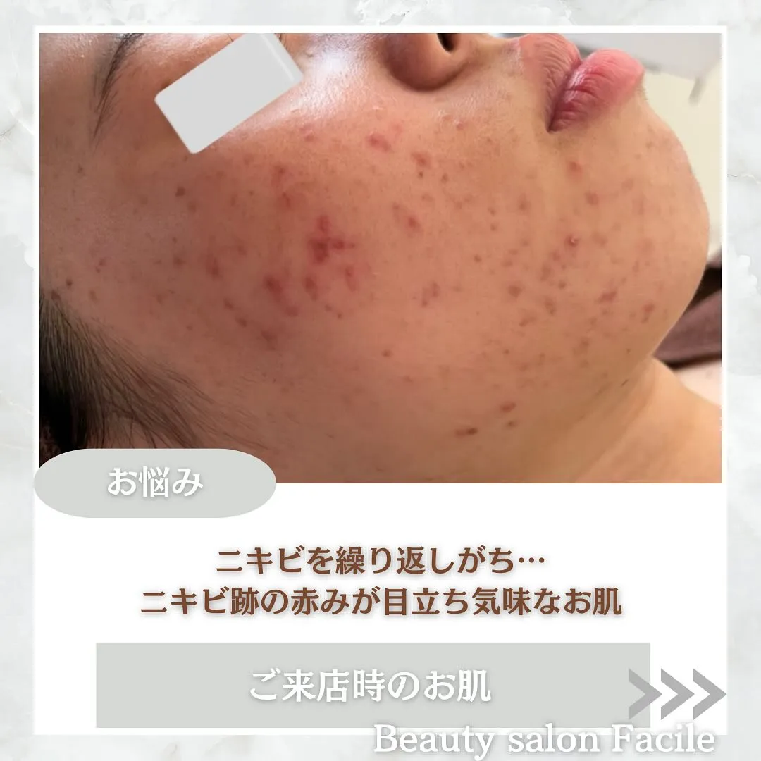 太田市にある頑固なニキビ専門店です✨️