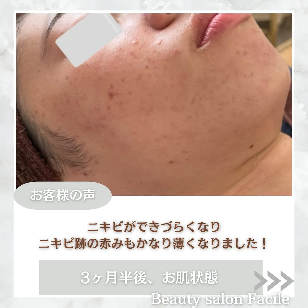 太田市にある頑固なニキビ専門店です✨️