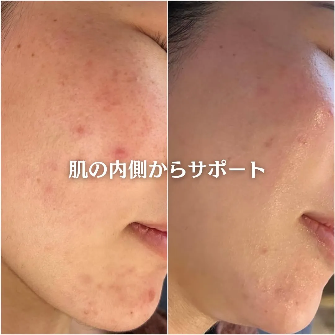 太田市にある頑固なニキビ専門店です✨️