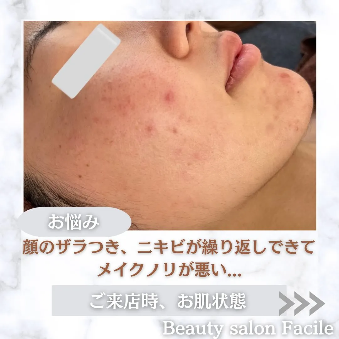 太田市にある頑固なニキビ専門店です✨️