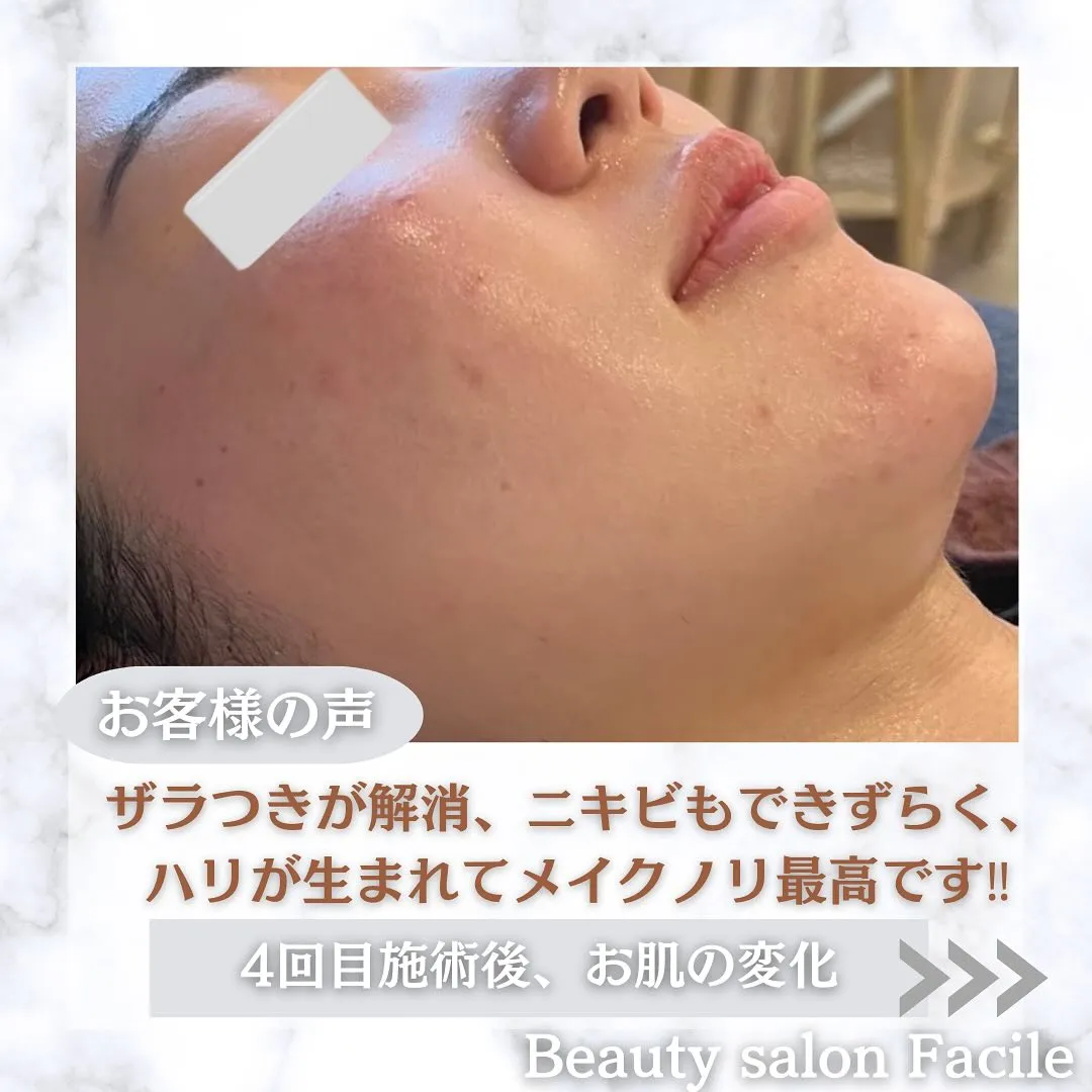 太田市にある頑固なニキビ専門店です✨️