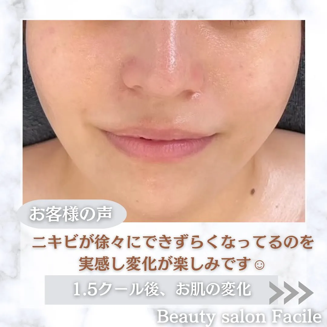 太田市にある頑固なニキビ専門店です✨️