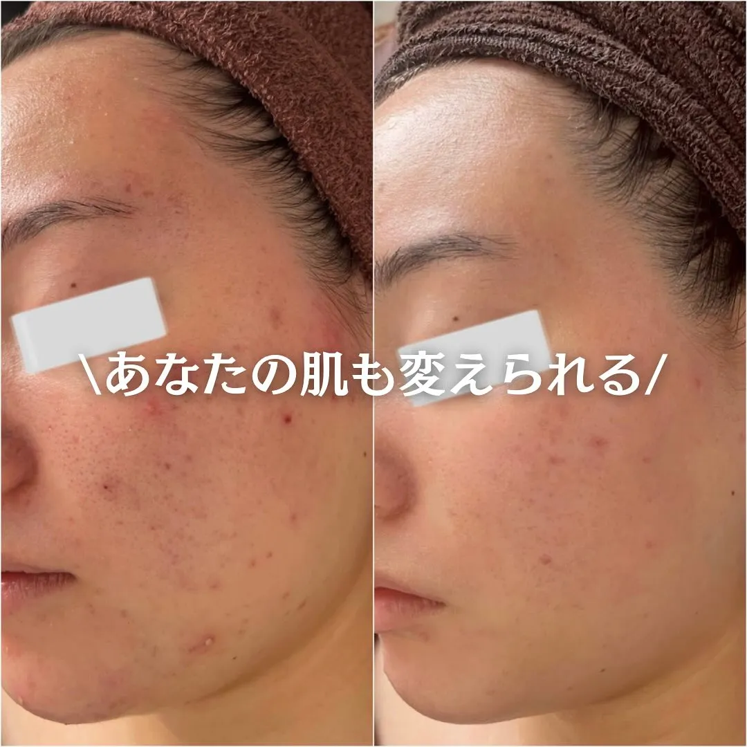 太田市にある頑固なニキビ専門店です✨️