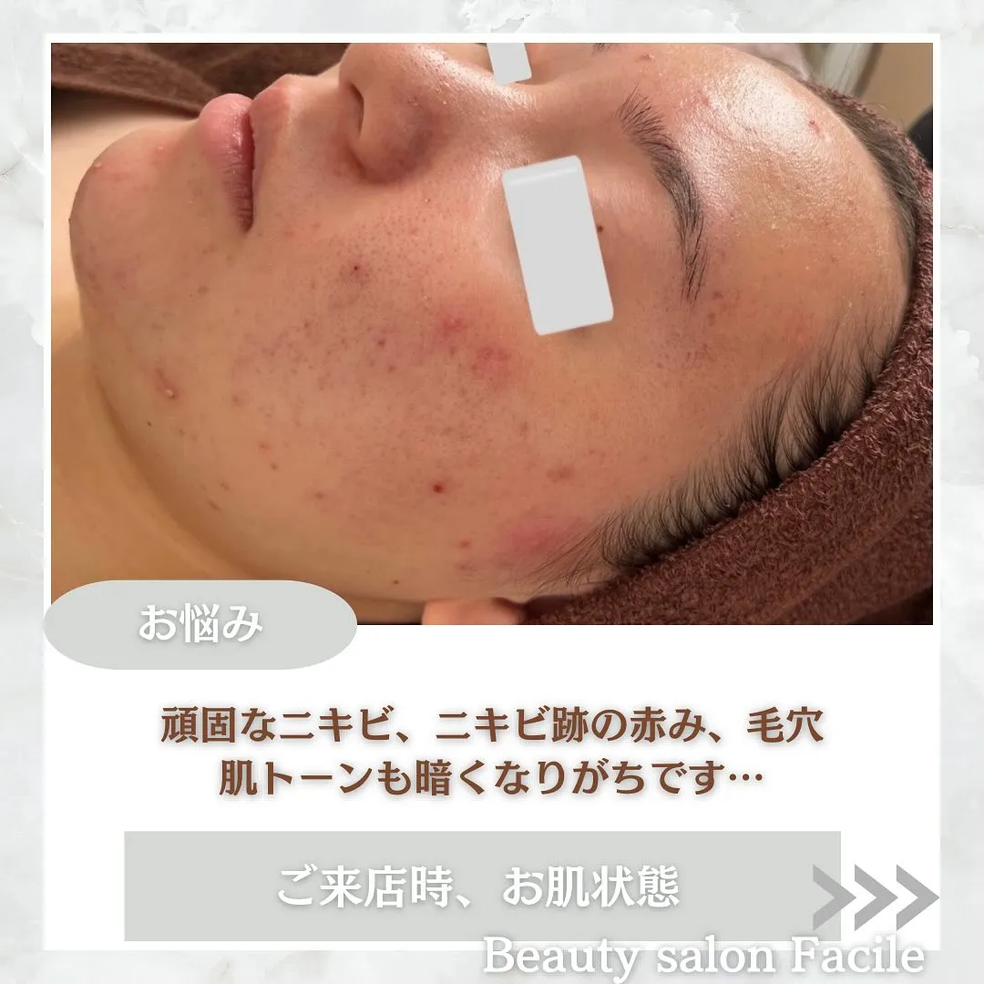 太田市にある頑固なニキビ専門店です✨️