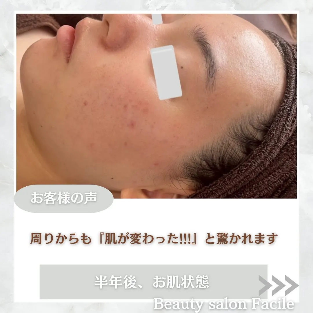 太田市にある頑固なニキビ専門店です✨️