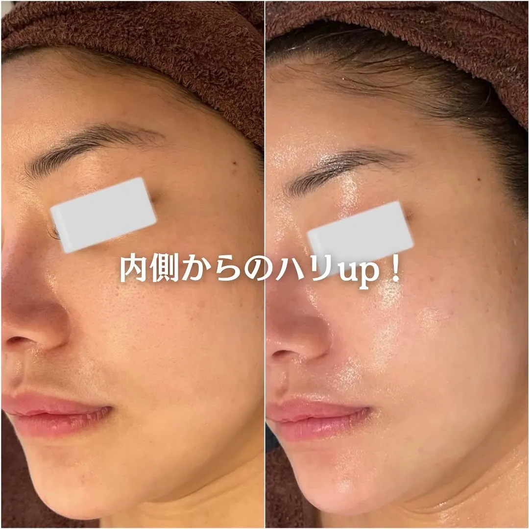 太田市にある頑固なニキビ専門店です✨️