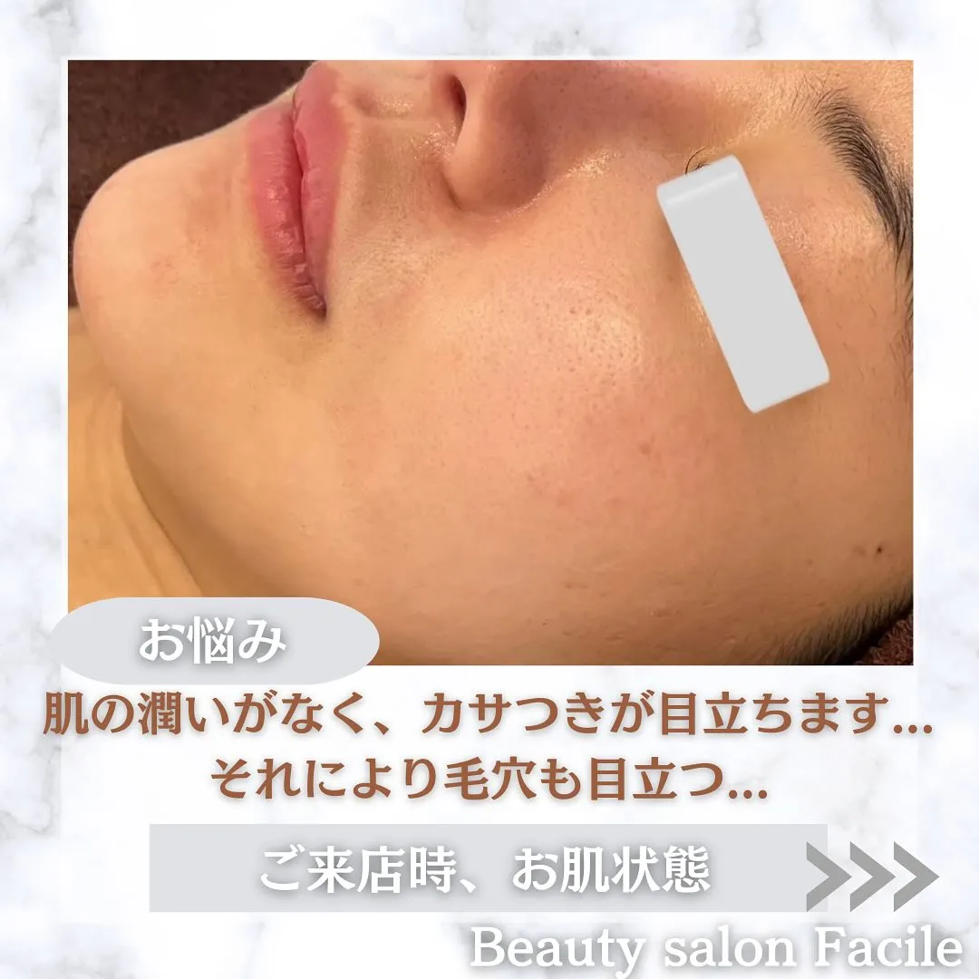 太田市にある頑固なニキビ専門店です✨️