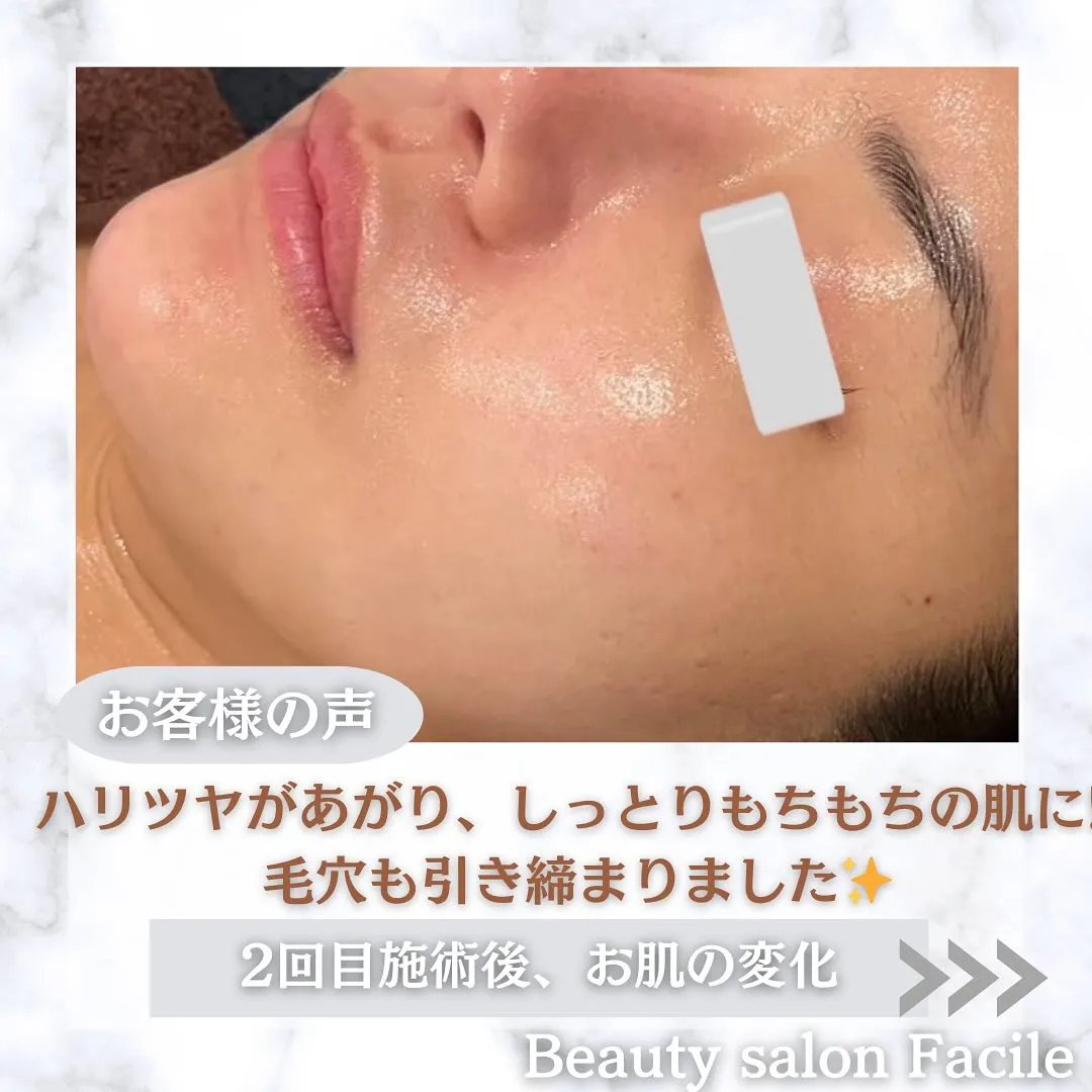 太田市にある頑固なニキビ専門店です✨️