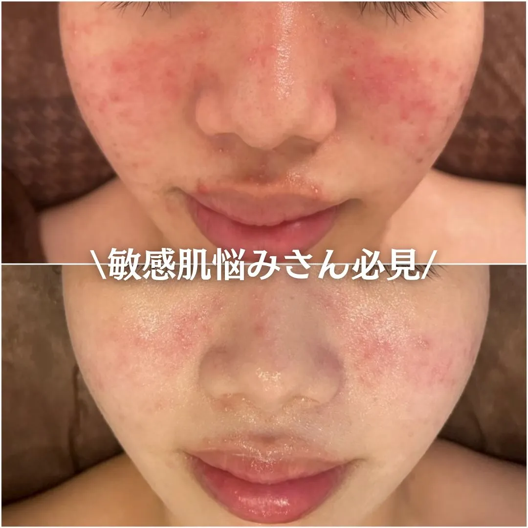 太田市にある頑固なニキビ専門店です✨️