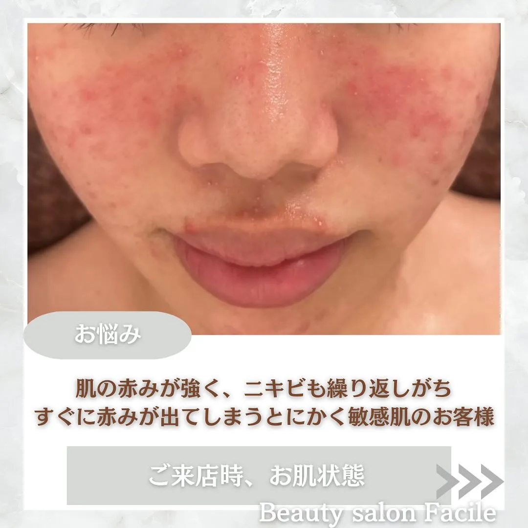 太田市にある頑固なニキビ専門店です✨️