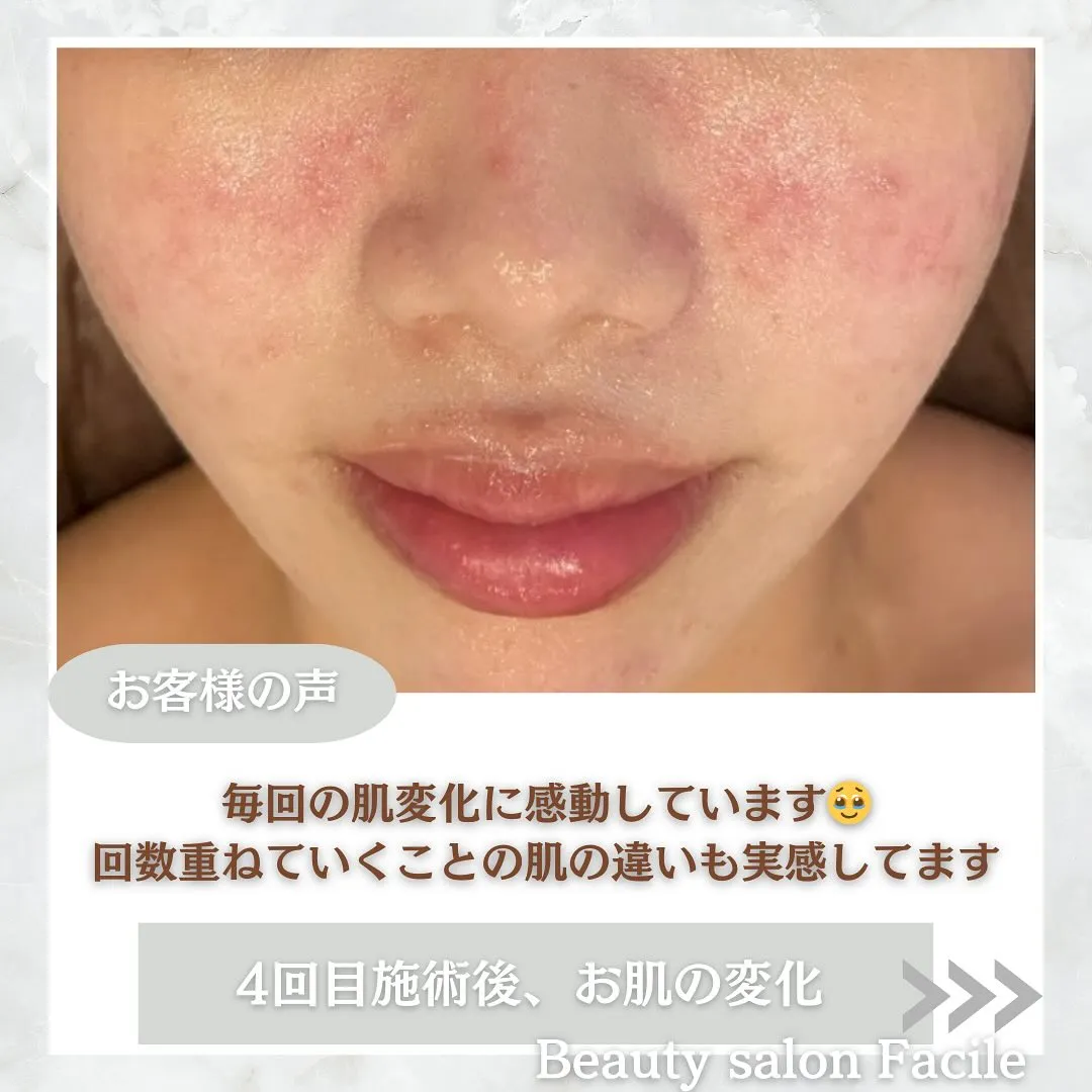 太田市にある頑固なニキビ専門店です✨️