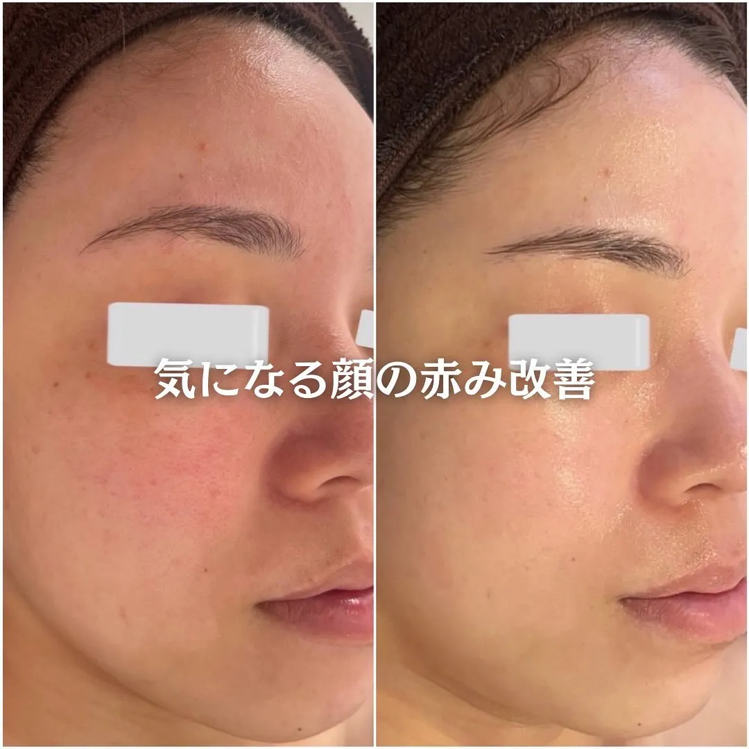 太田市にある頑固なニキビ専門店です✨️