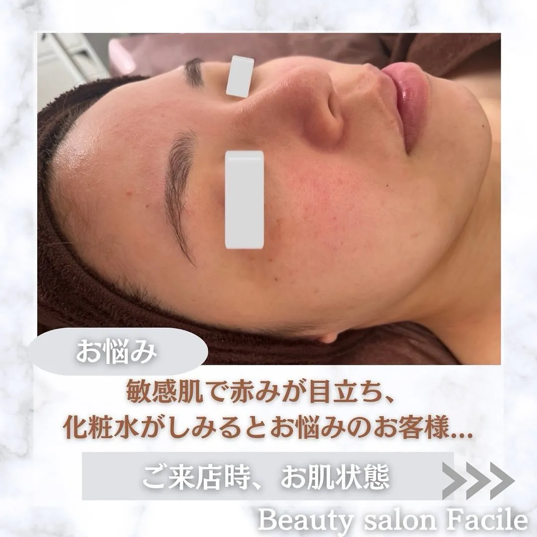 太田市にある頑固なニキビ専門店です✨️