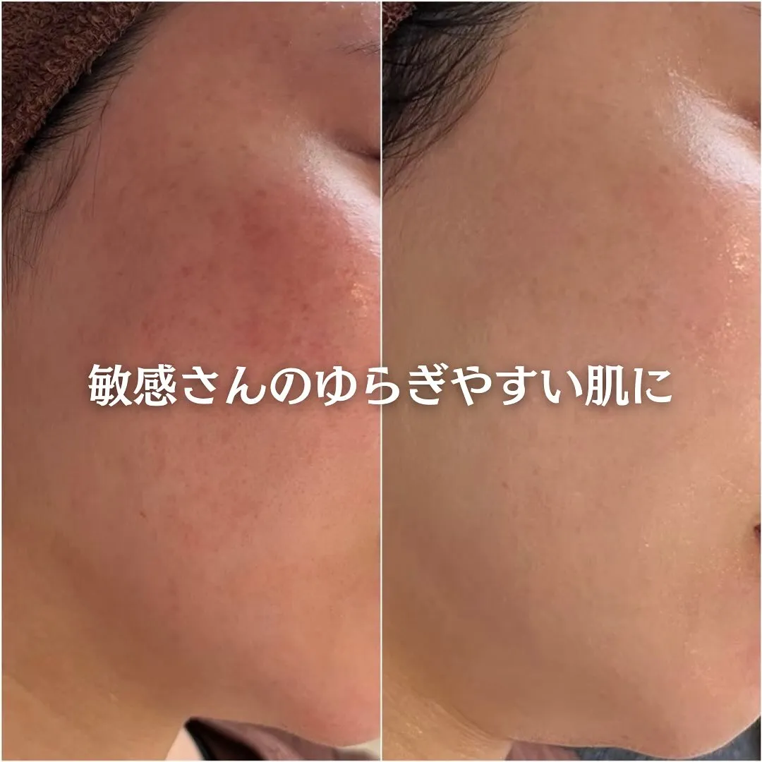 太田市にある頑固なニキビ専門店です✨️