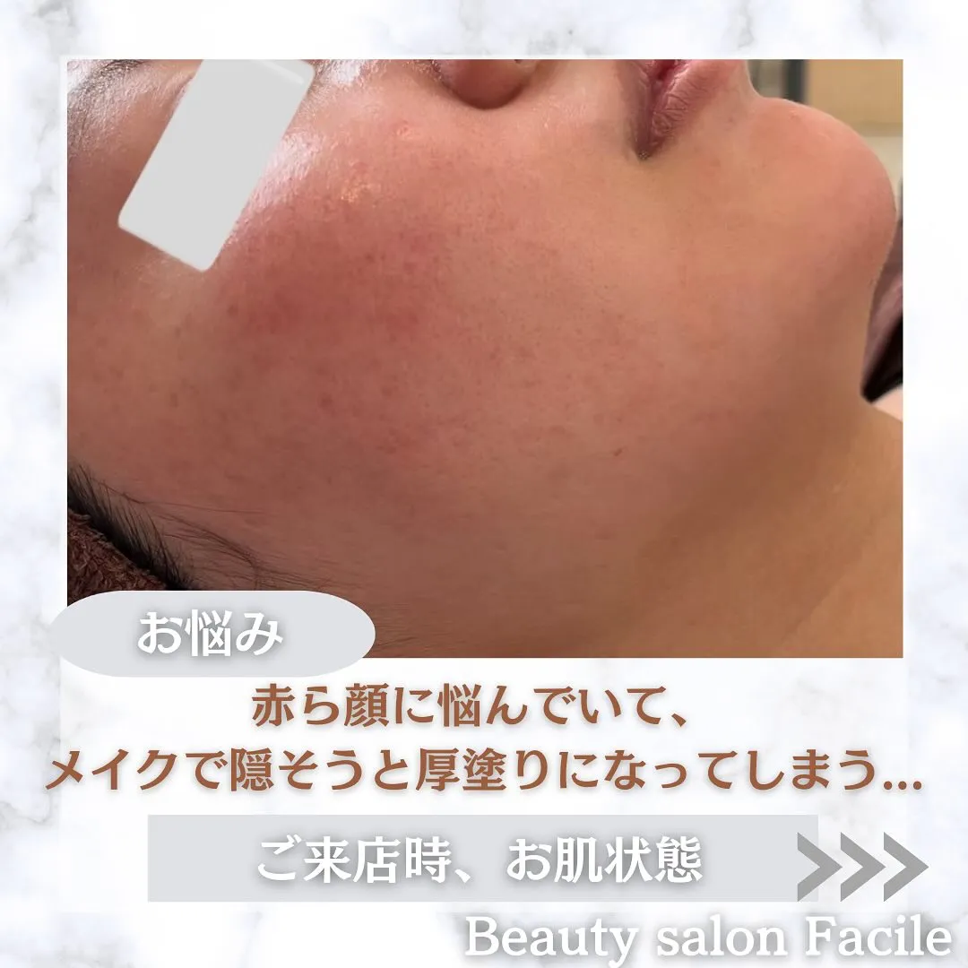 太田市にある頑固なニキビ専門店です✨️