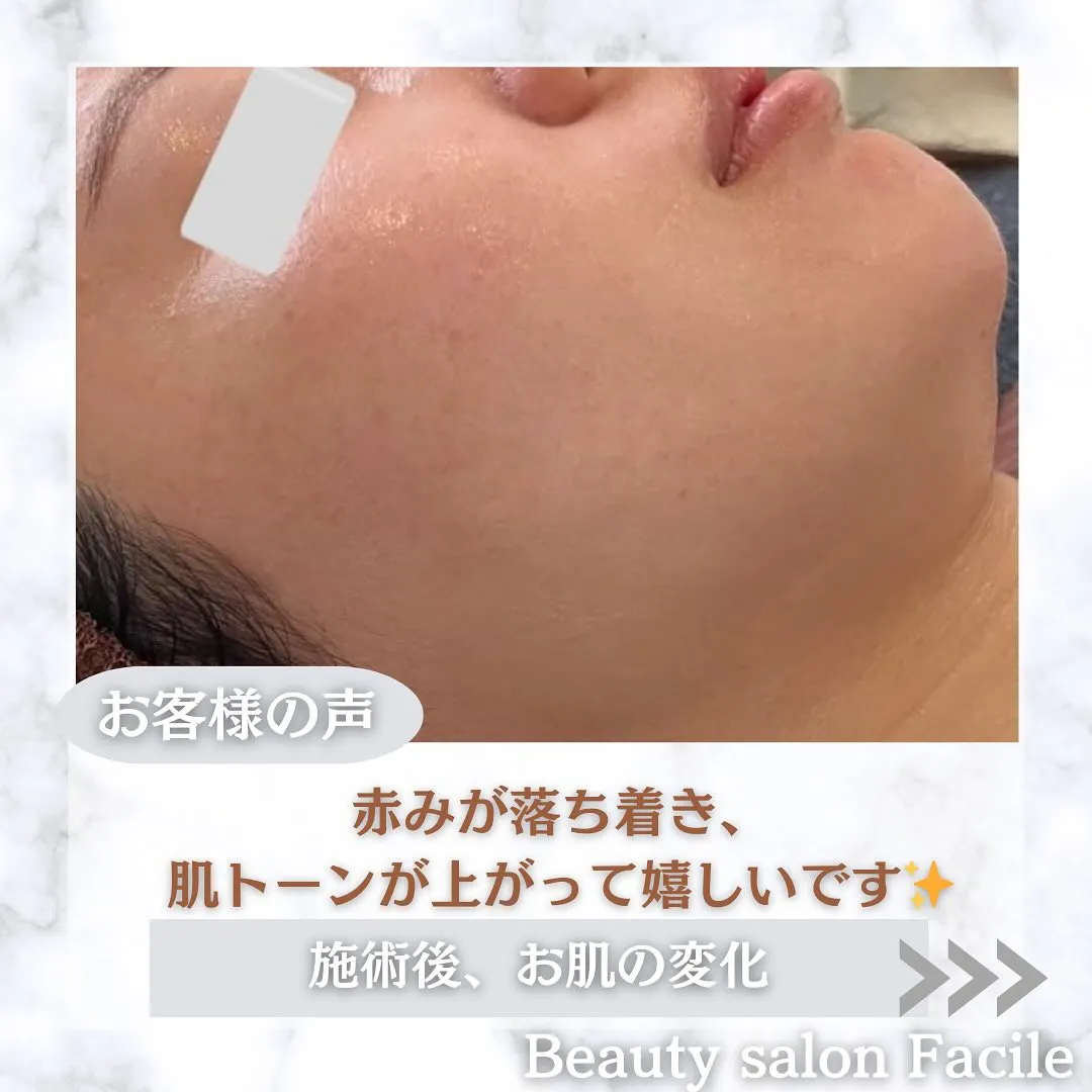 太田市にある頑固なニキビ専門店です✨️