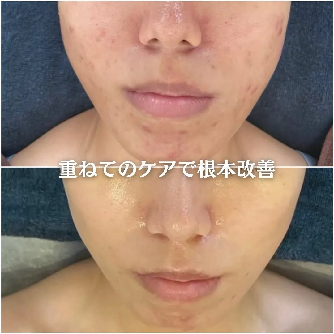 太田市にある頑固なニキビ専門店です✨️