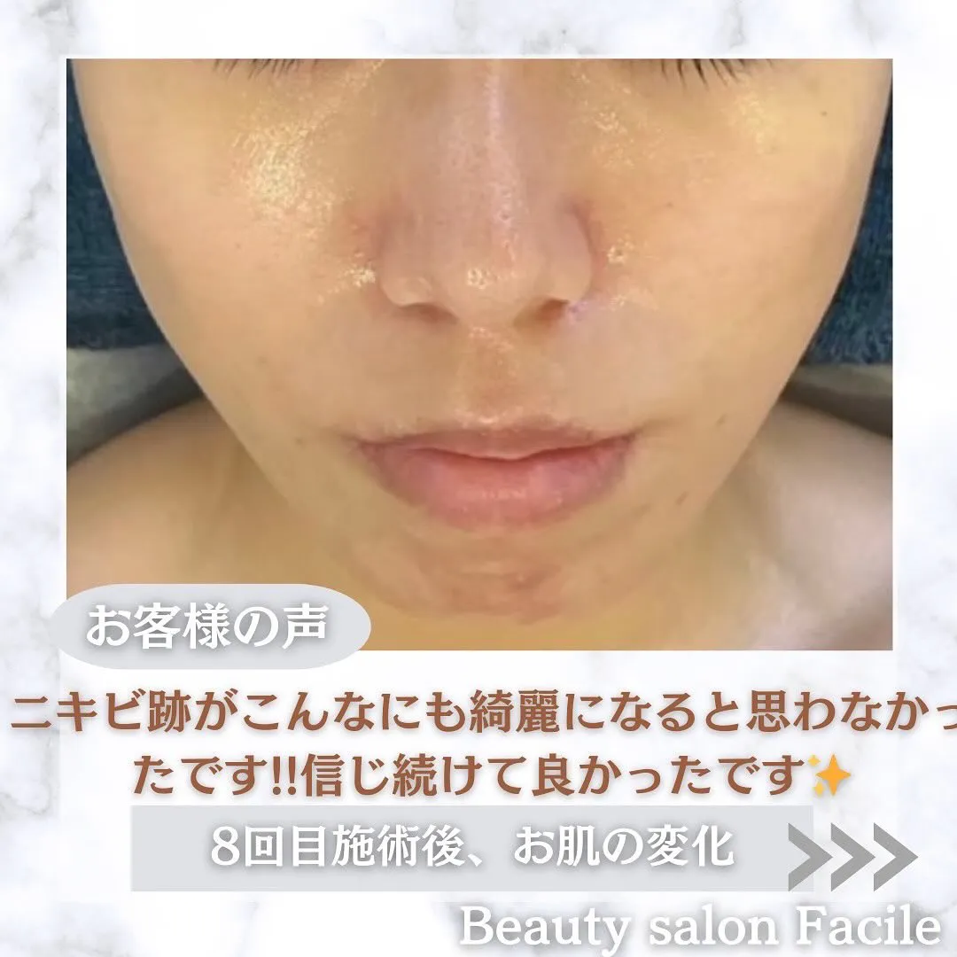 太田市にある頑固なニキビ専門店です✨️