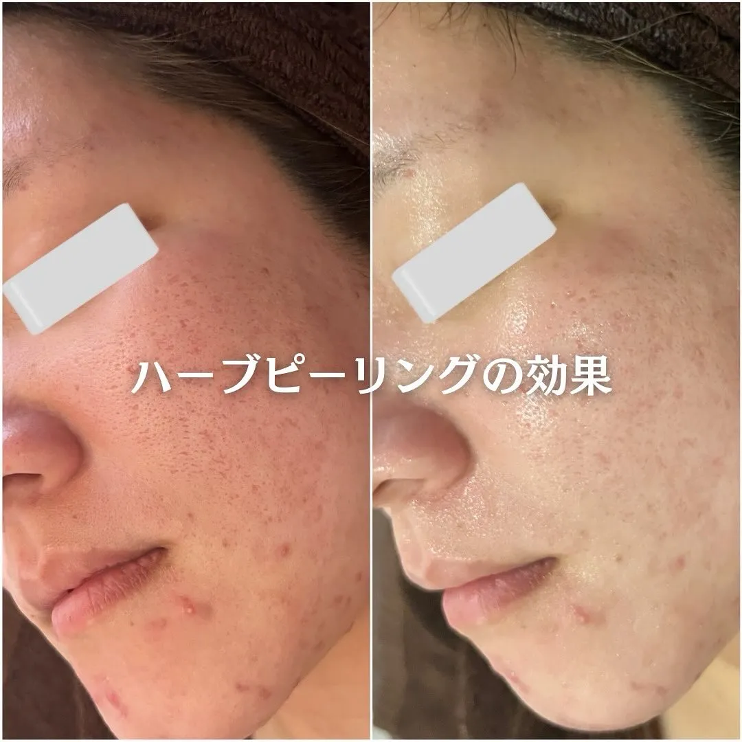 太田市にある頑固なニキビ専門店です✨️