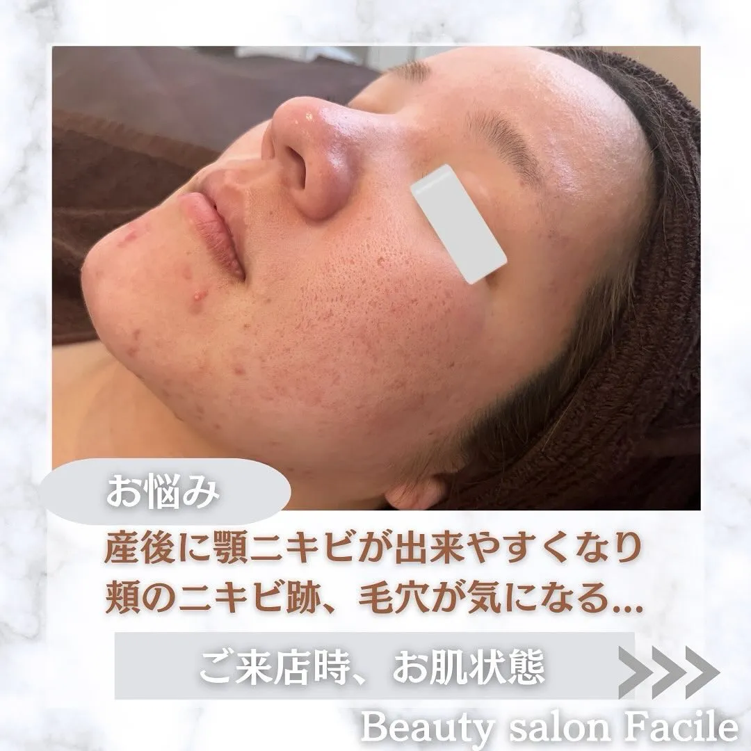 太田市にある頑固なニキビ専門店です✨️