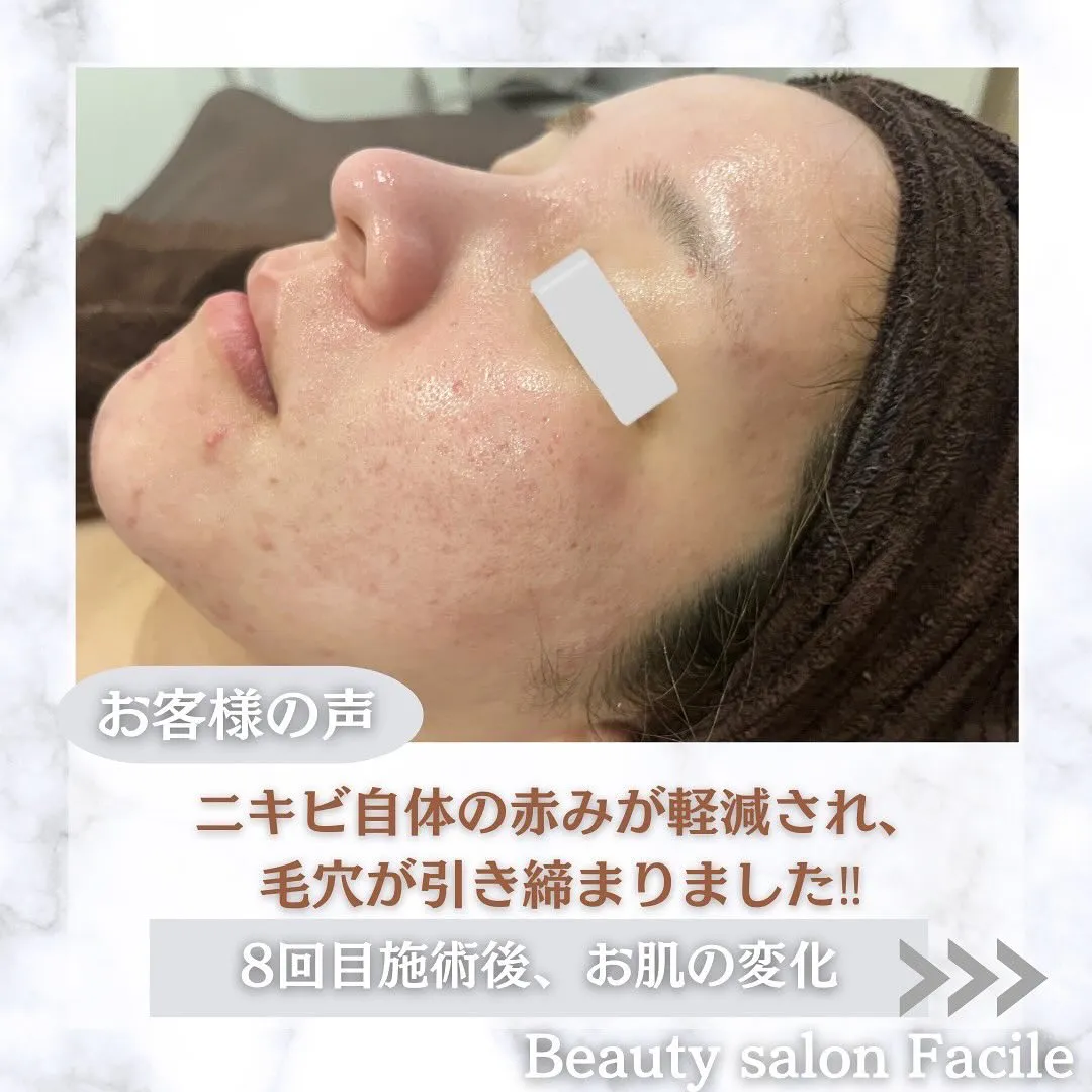 太田市にある頑固なニキビ専門店です✨️