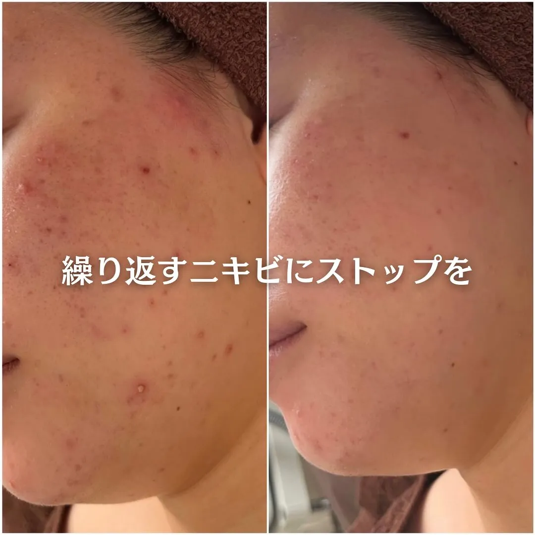 太田市にある頑固なニキビ専門店です✨️