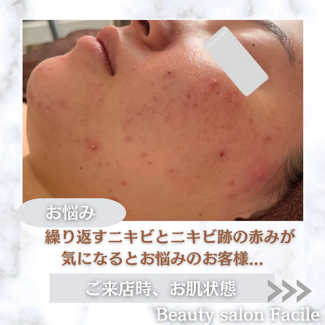 太田市にある頑固なニキビ専門店です✨️