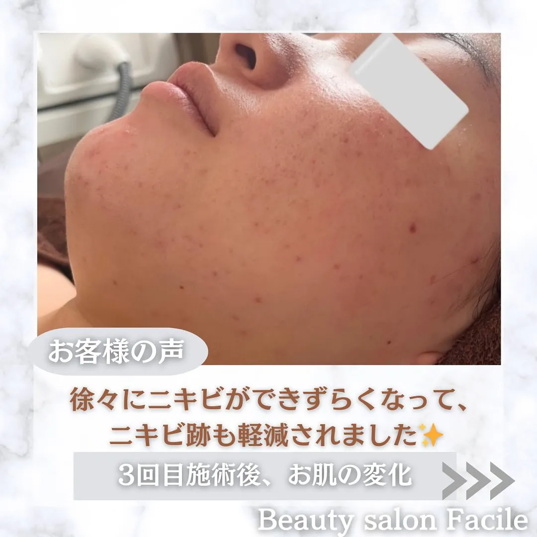 太田市にある頑固なニキビ専門店です✨️