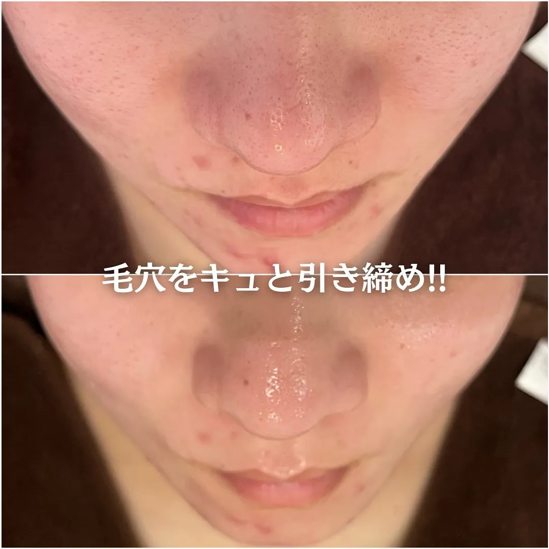 太田市にある頑固なニキビ専門店です✨️