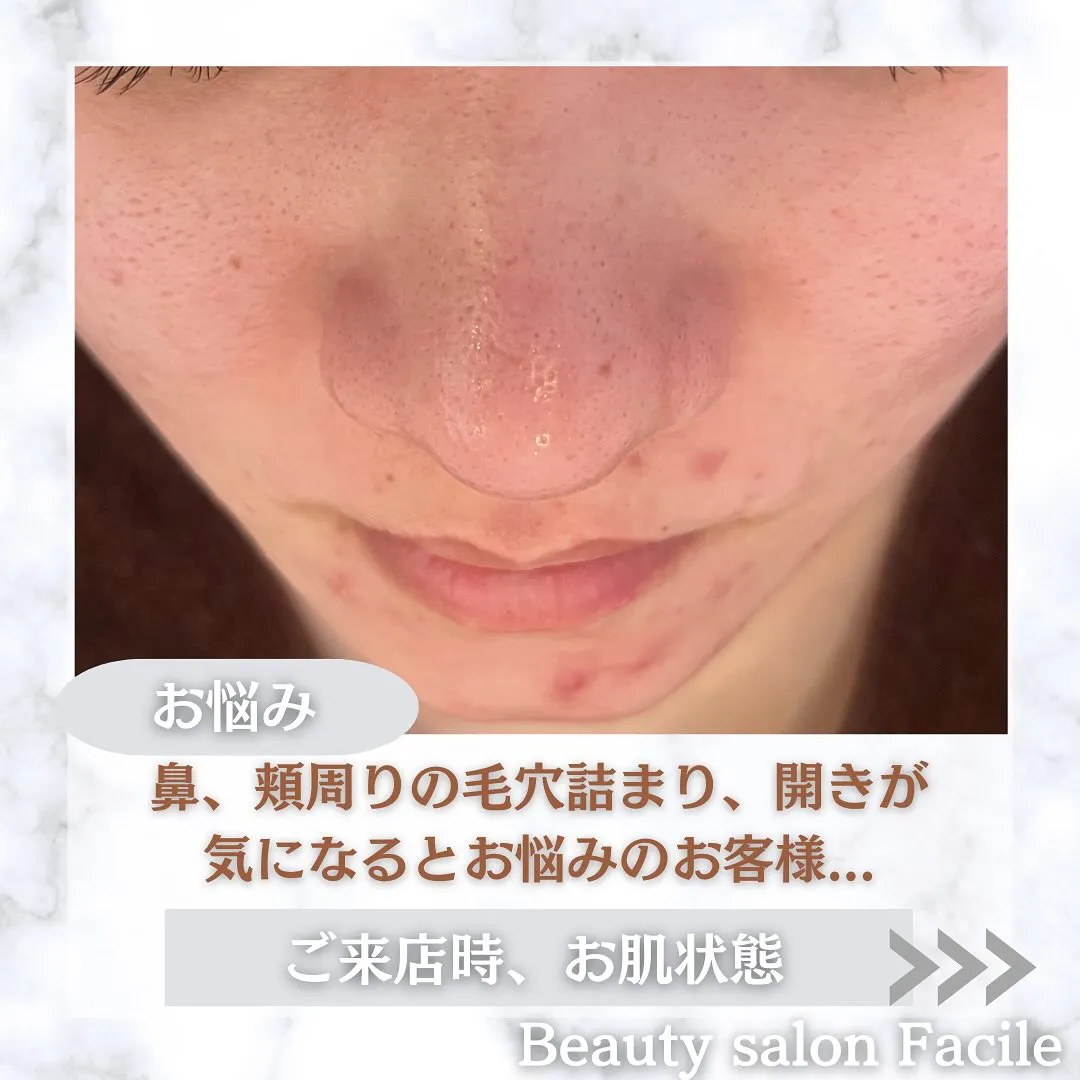 太田市にある頑固なニキビ専門店です✨️