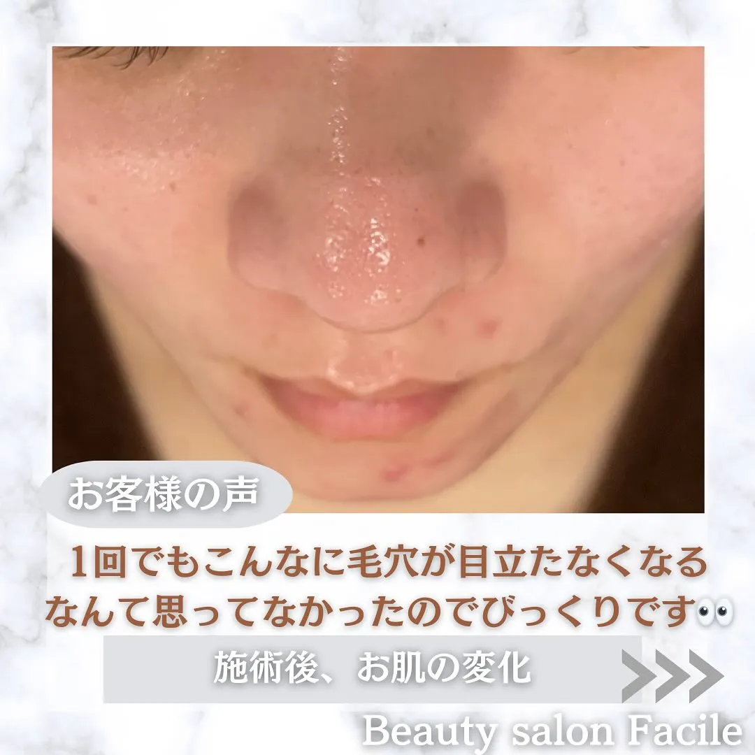 太田市にある頑固なニキビ専門店です✨️