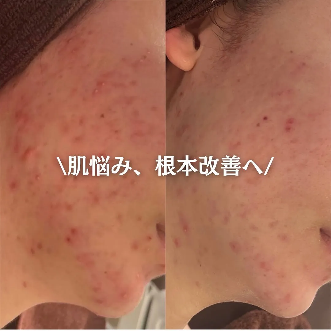 太田市にある頑固なニキビ専門店です✨️