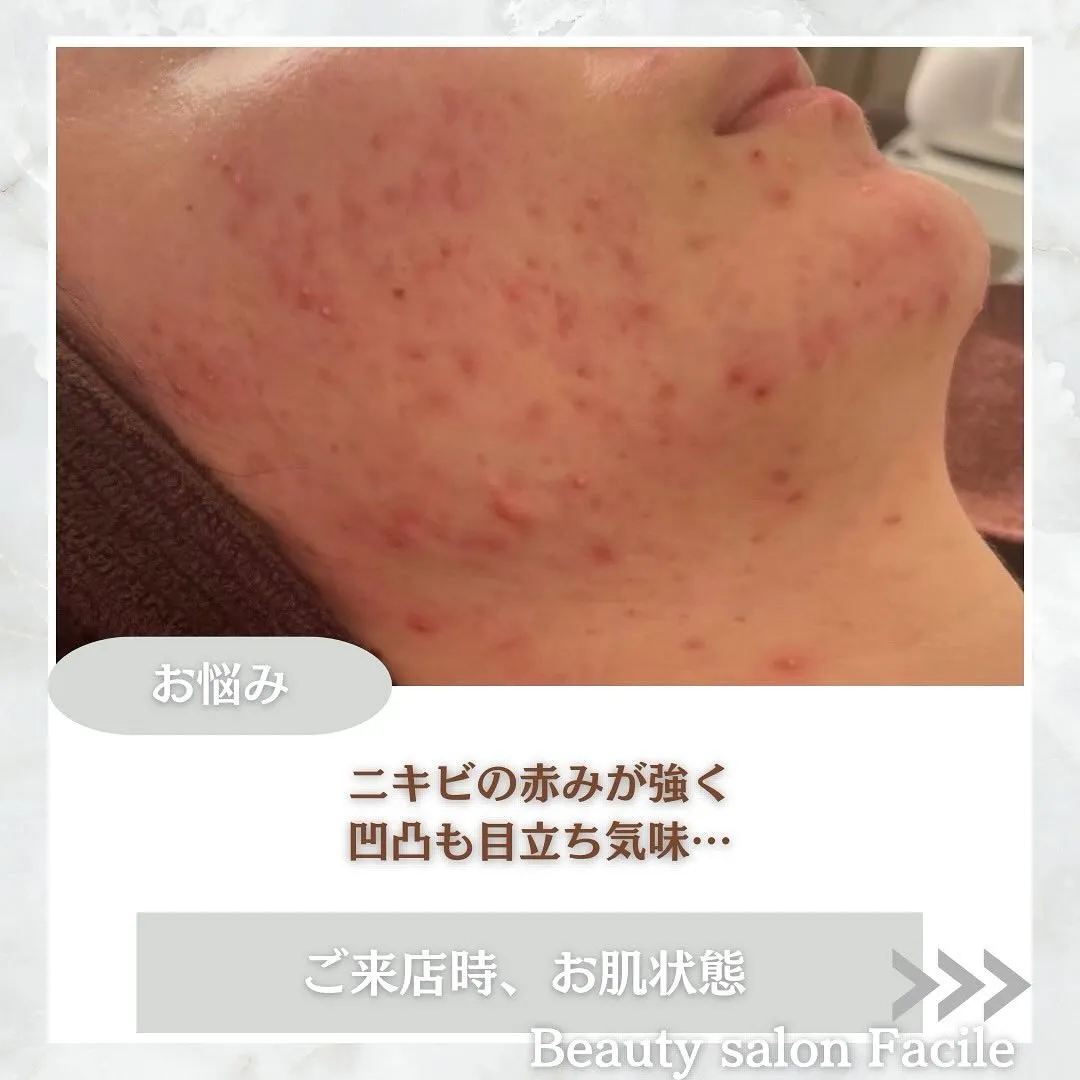 太田市にある頑固なニキビ専門店です✨️