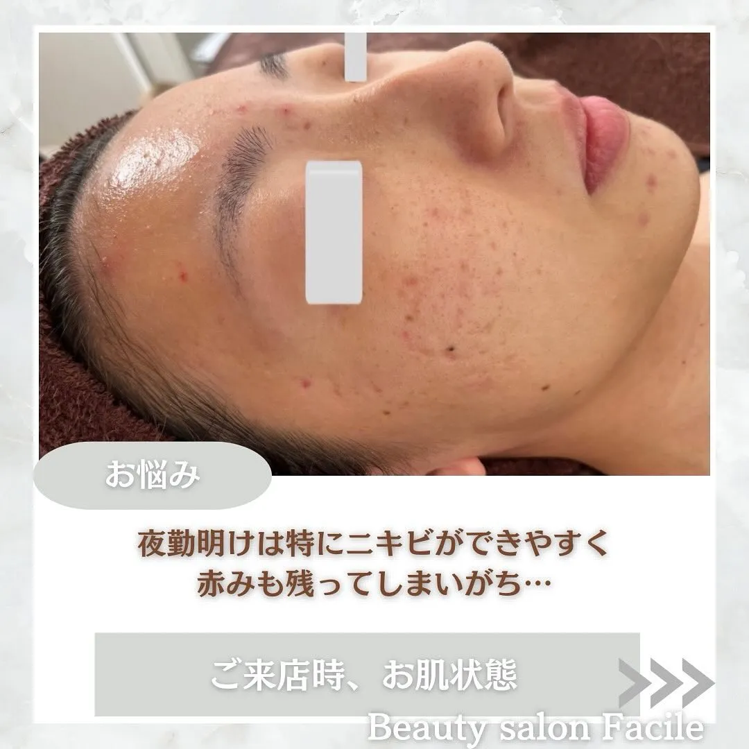 太田市にある頑固なニキビ専門店です✨️