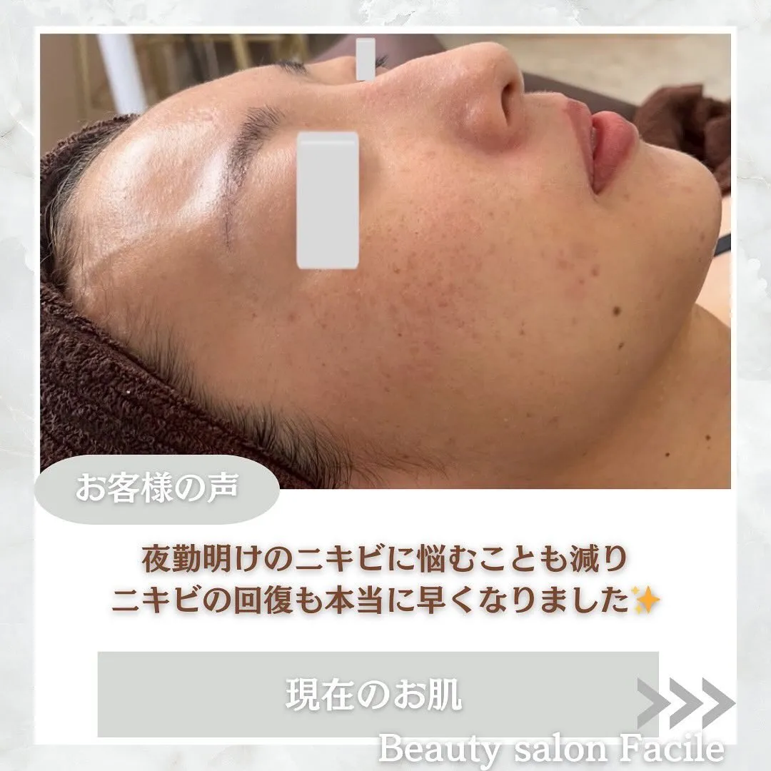 太田市にある頑固なニキビ専門店です✨️