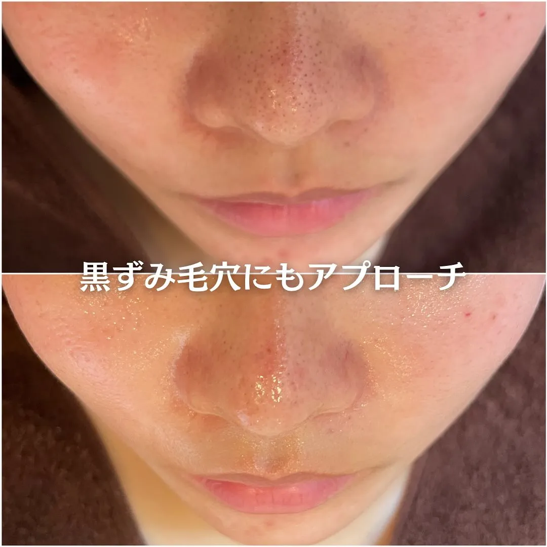 太田市にある頑固なニキビ専門店です✨️