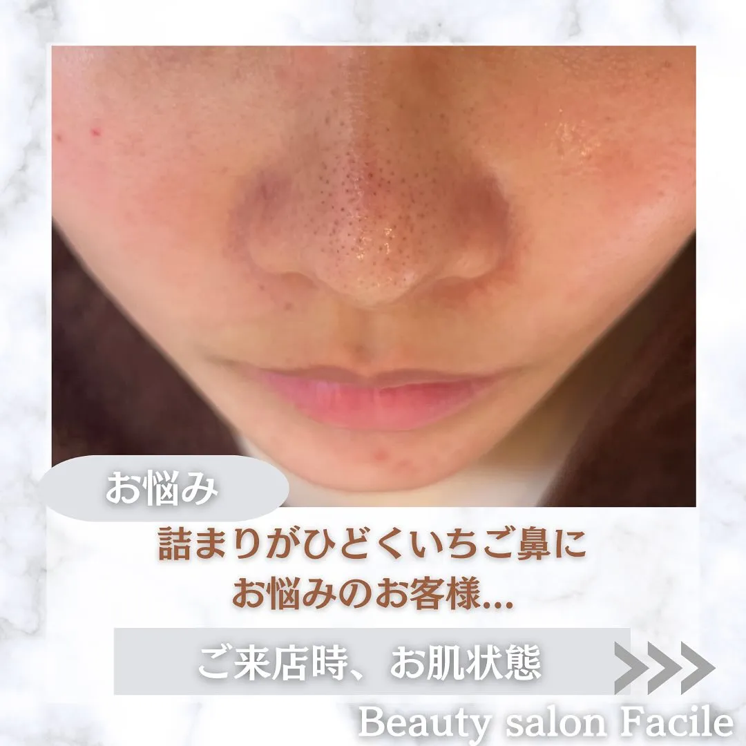 太田市にある頑固なニキビ専門店です✨️