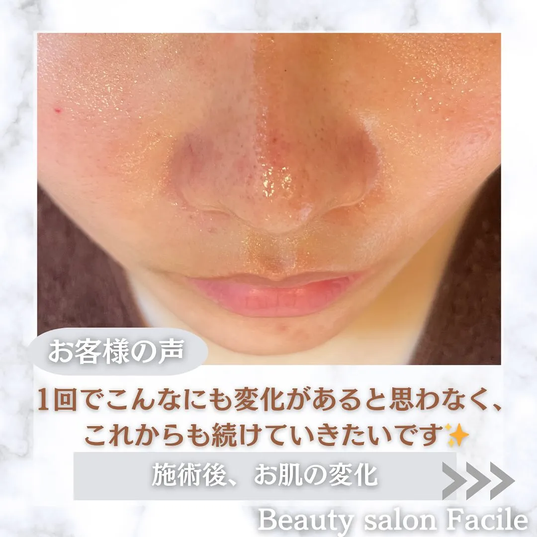 太田市にある頑固なニキビ専門店です✨️