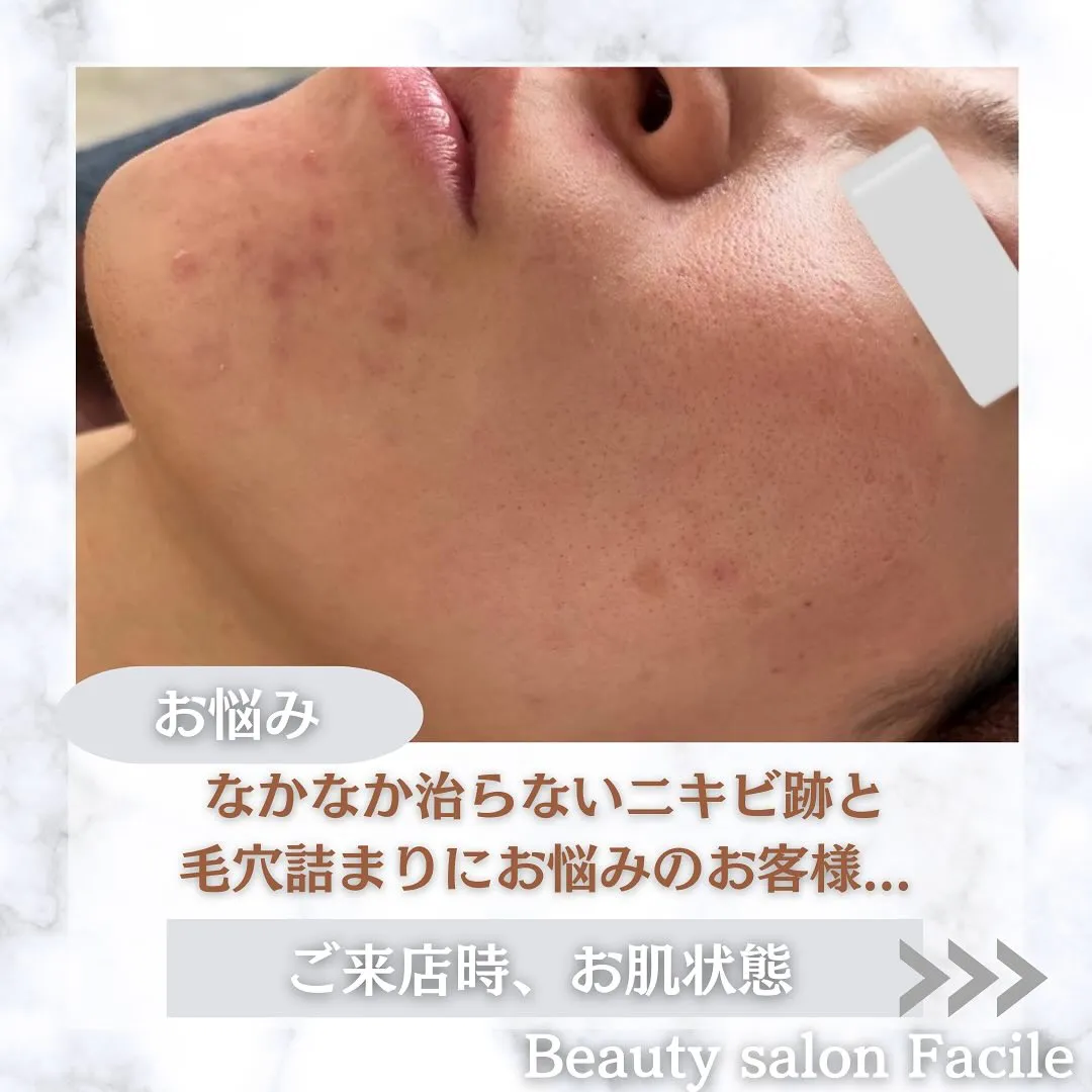 太田市にある頑固なニキビ専門店です✨️