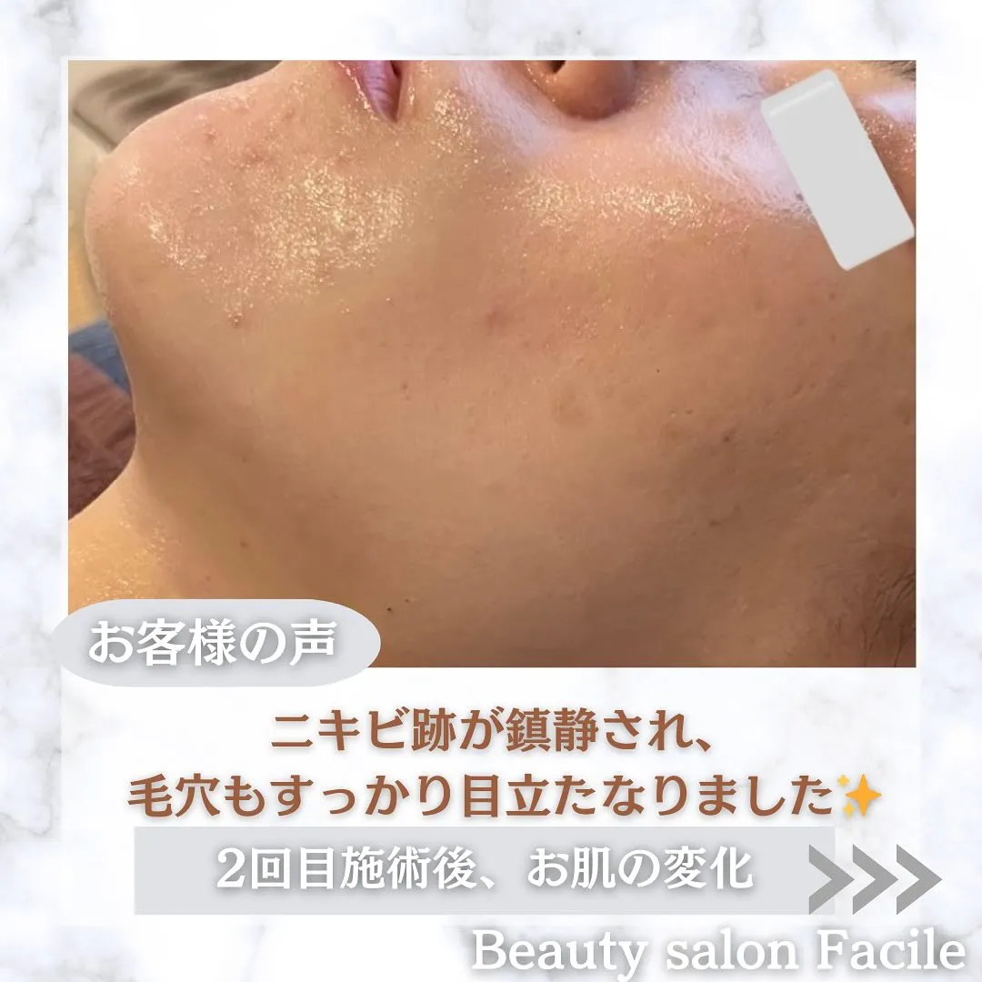 太田市にある頑固なニキビ専門店です✨️