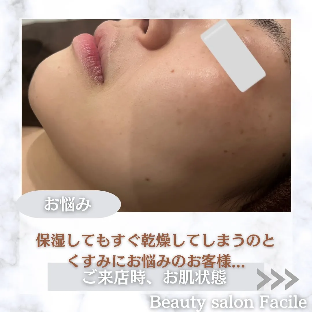 太田市にある頑固なニキビ専門店です✨️