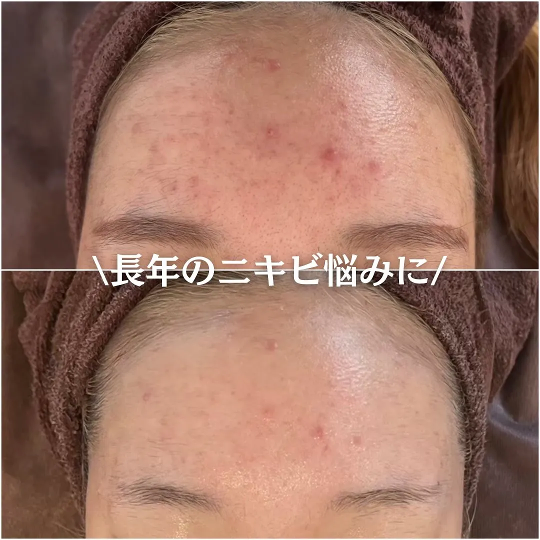 太田市にある頑固なニキビ専門店です✨️