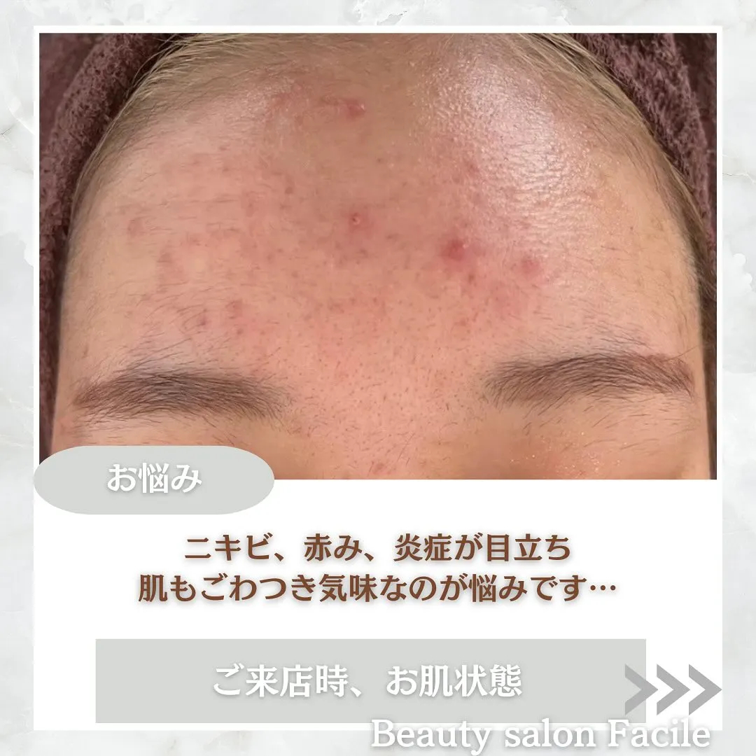 太田市にある頑固なニキビ専門店です✨️