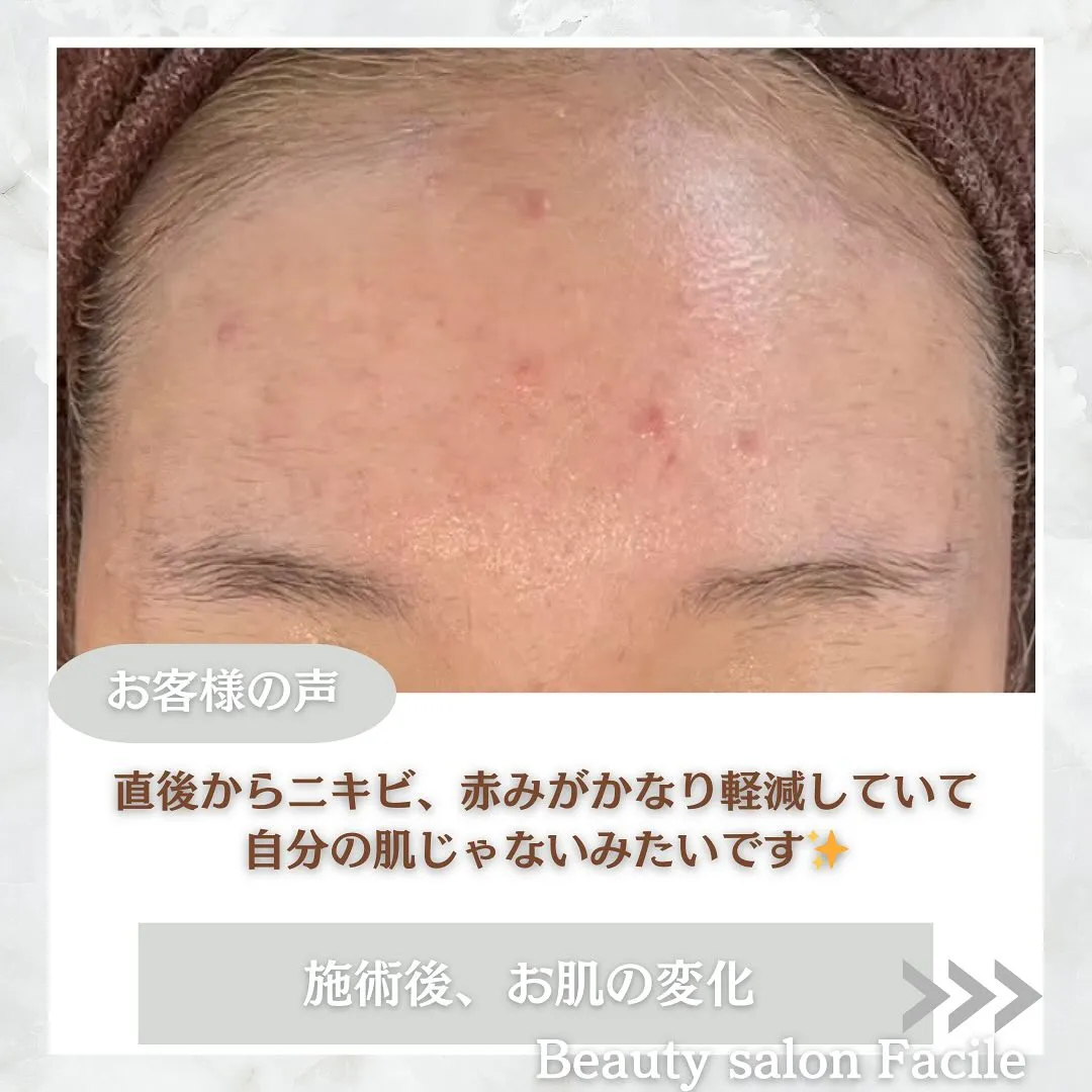 太田市にある頑固なニキビ専門店です✨️